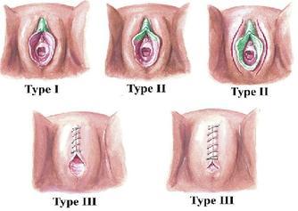 3-types-of-fgm1_001.jpg